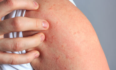 GARD shows great potential for allergy testing in e-liquids