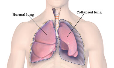 A very rare tragedy – how vaping could have contributed to a teenager’s death